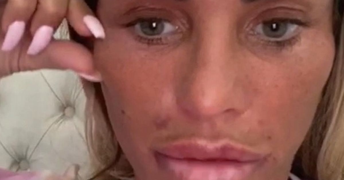 Katie Price ‘suffered lip filler mishap and couldn’t smile’ before Turkey trip