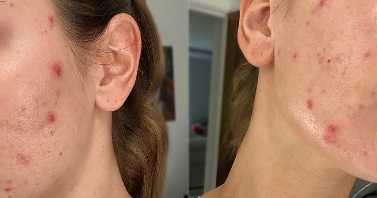 Sam Faiers shares secret acne battle after getting spots while breastfeeding