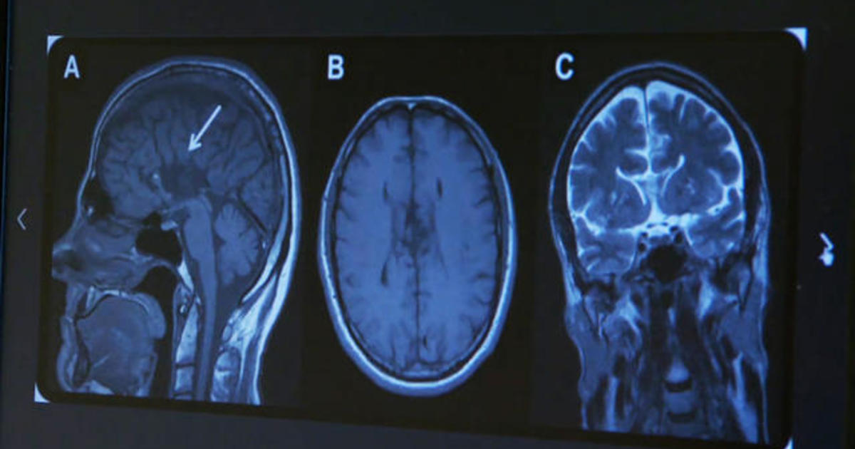 Brain abnormalities from mild concussions may last months