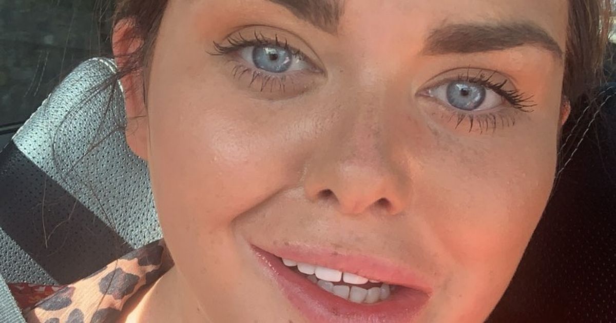 Scarlett Moffatt shows off her lopsided smile after getting her teeth done