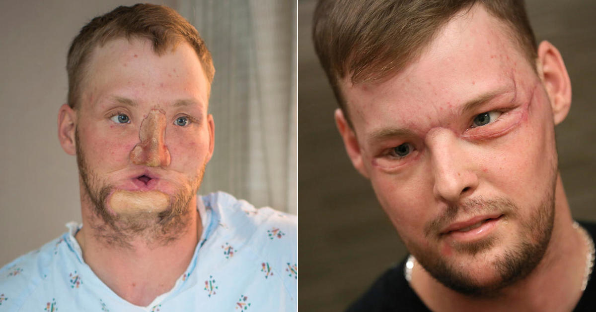 Amazing face transplants (GRAPHIC IMAGES)