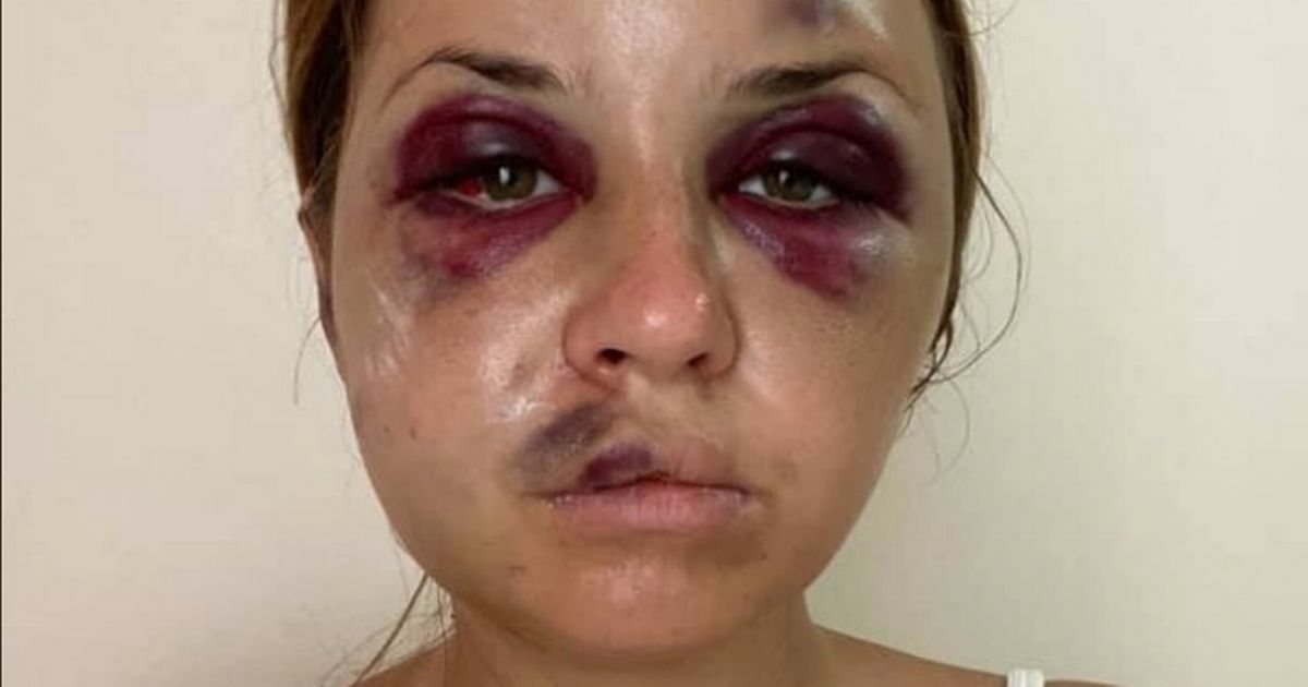 TV star suffers brutal face injuries as she escapes being raped in front of son