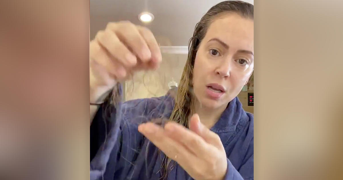 Alyssa Milano says she’s losing her hair after long battle with COVID-19