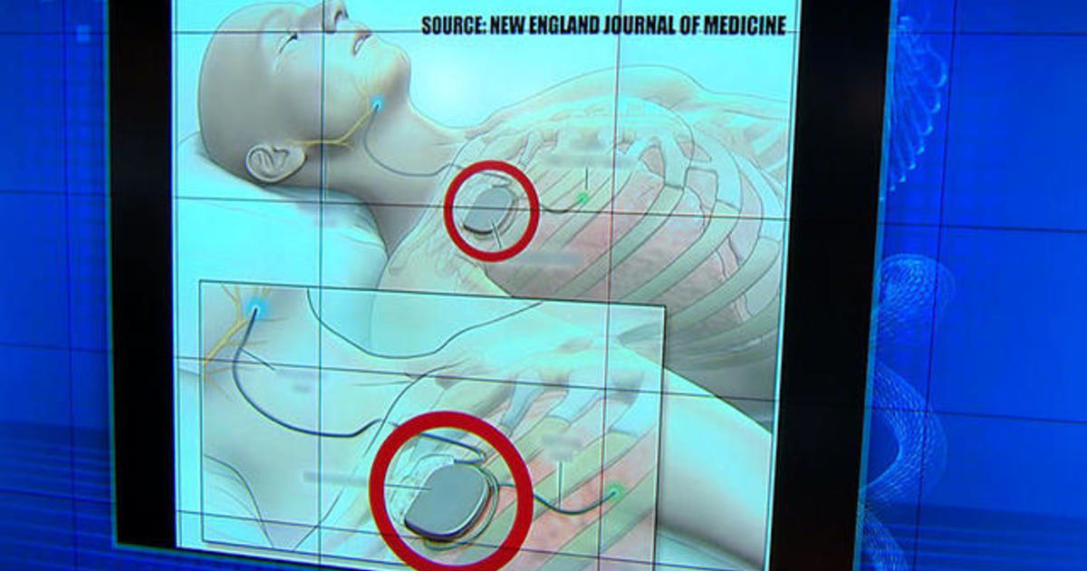 New sleep apnea treatment uses nerve stimulation