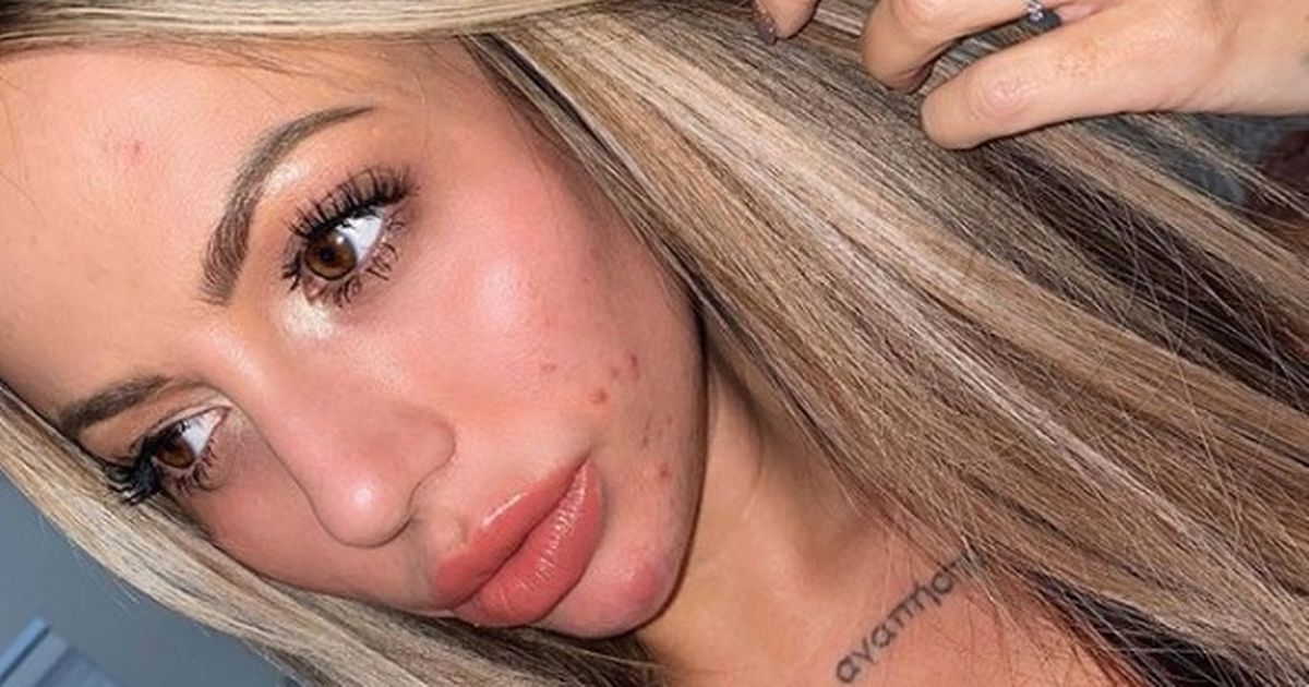 Holly Hagan bravely opens up about acne battle after searching for ‘perfection’