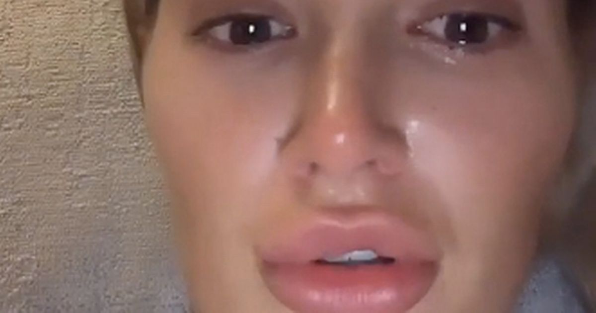 Molly-Mae Hague breaks down in tears as she shares skin cancer scare