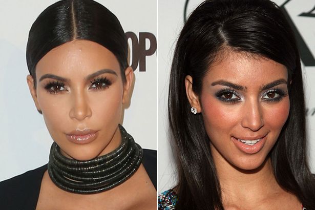 Kim Kardashian's lasered hairline