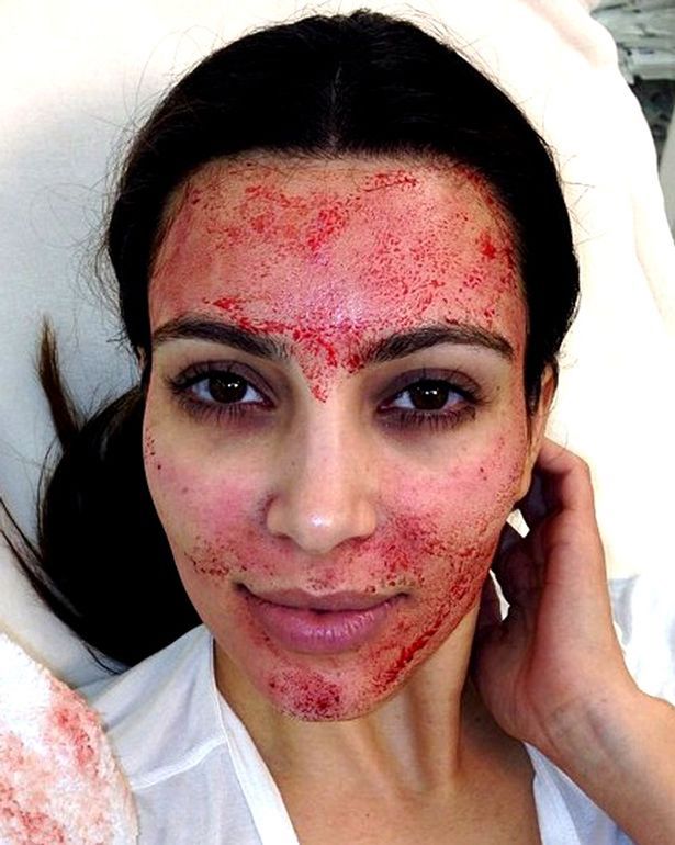 Kim underwent an agonising 'vampire' facial