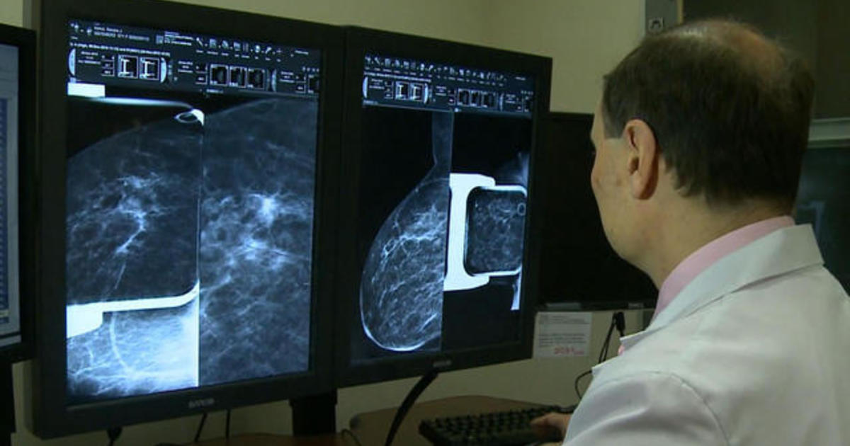 Breast cancer screenings plummet during coronavirus pandemic