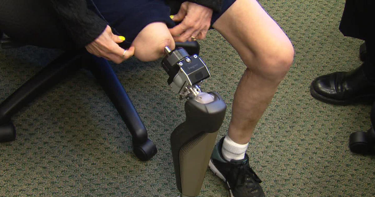 A giant step forward for users of artificial legs