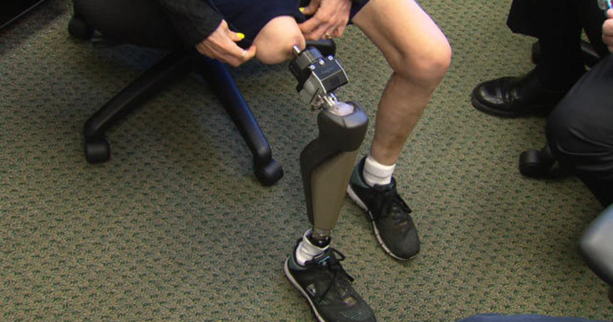 A giant step forward in artificial legs