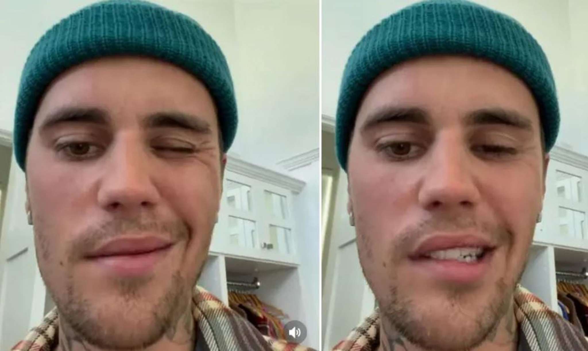 Can’t smile and blink with one eye 28-year-old Justin Bieber paralyzed half of his face