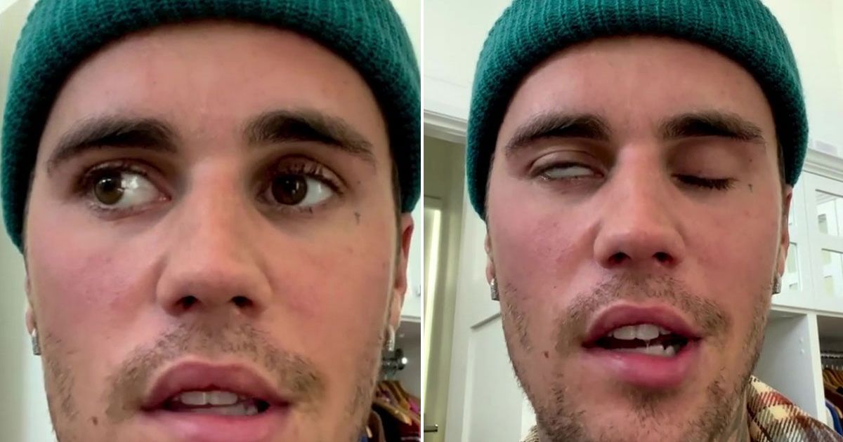 Justin Bieber’s ‘severe’ facial paralysis could cause ‘long-term’ damage, expert says