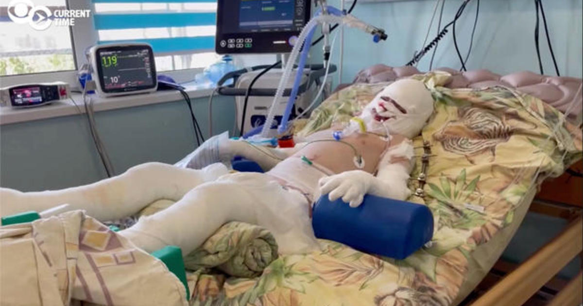 Russian missile strike leaves 7-year-old boy with burns on nearly half of his body