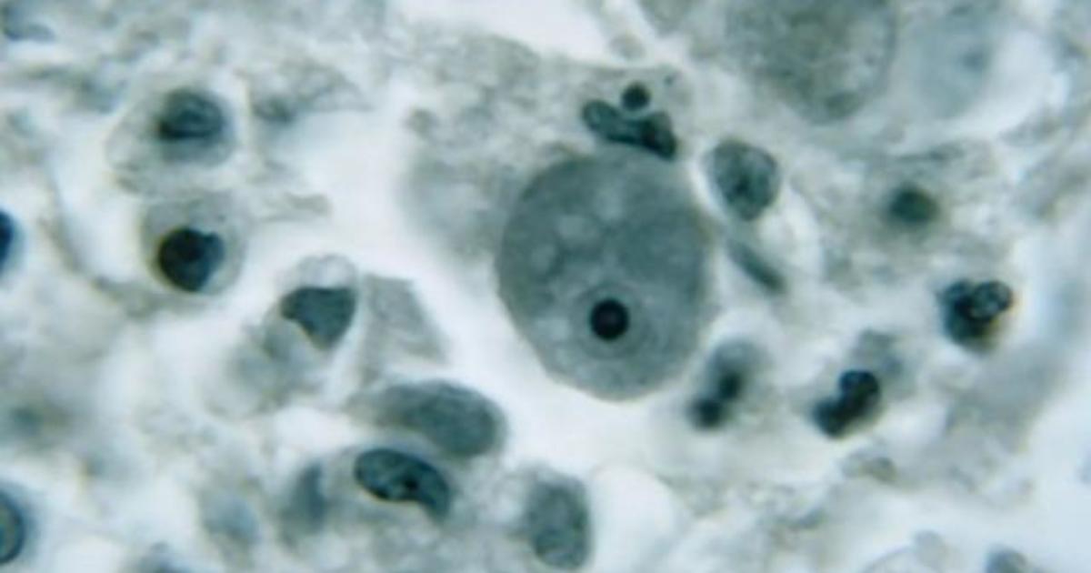 Brain-eating amoeba suspected in Nebraska child’s death